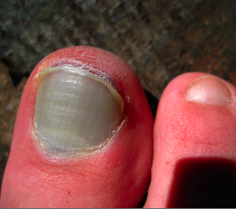 Smashed Toe